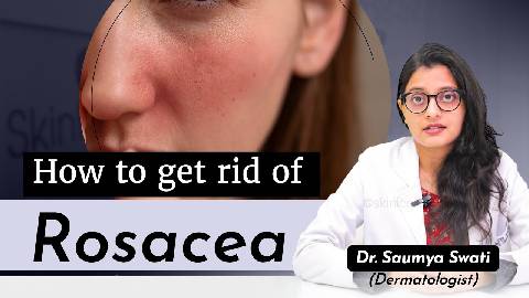 How to get rid of Rosacea? | Causes & Treatment | Best Skin Specialist in Noida | Skinlogics Clinic