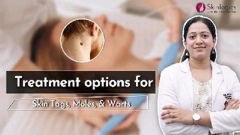Skin tags, Moles & Warts से कैसे पाएँ छुटकारा | Treatment for Common Skin Conditions | Skinlogics