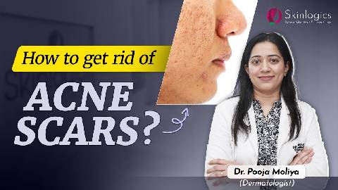 How to get rid of Acne Scars | MNRF treatment for Acne Scars | Best Skin Specialist in Noida