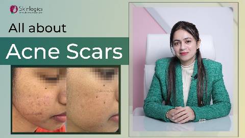 Everything you need to know about Acne Scars | Types, Causes & Treatment | Skinlogics