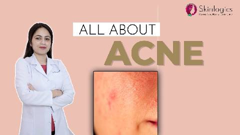 What is Acne? | Types of Acne | Causes of Acne, Acne Treatments | Skinlogics Derma Clinic