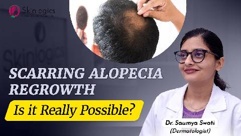 Scarring Alopecia Regrowth | Hair Fall Treatment | Best Hair Fall Treatment in Noida | Skinlogics