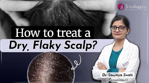 How to treat a Dry, Flaky Scalp? | Causes & Treatment of Dandruff | Hair Fall Doctor in Noida