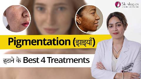 4 Best Treatments for Melasma, Skin Pigmentation and Dark Spots