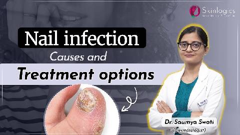 Nail Infection - Causes & Treatment | How to treat Nail Infection