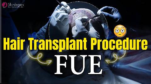 Hair Transplant Procedure | FUE Hair Transplant
