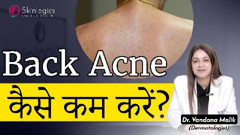 Back Acne | Truncal Acne