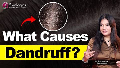What is Dandruff? | Causes And Treatment