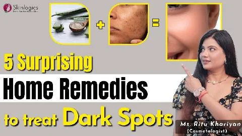 Pigmentation home remedies | Pigmentation Treatment in Noida