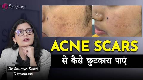 Acne Scars Treatment | से कैसे छुटकारा पाएं