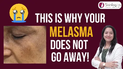 Melasma Mistakes to Avoid | Best Melasma Treatment in Noida | Skin Lightening Treatment in Noida