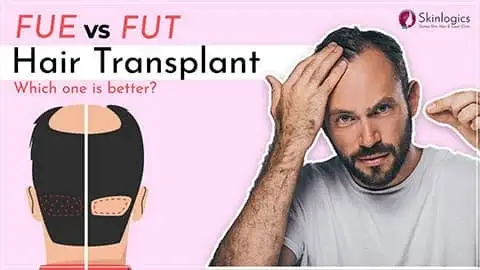 Hair Transplant Procedure | FUE Hair Transplant