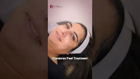 Cosmelan Peel | Chemical Peel Treatment