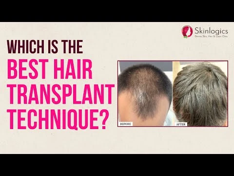 FUE vs FUT Hair Transplant - Which is better? | Skinlogics Derma Clinic