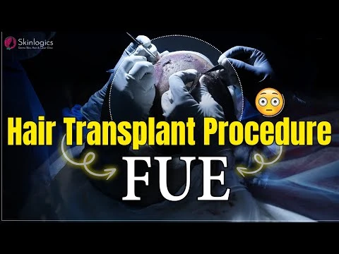 Hair Transplant Procedure | FUE Hair Transplant |Hair Transplant in Noida | Skinlogics Clinic