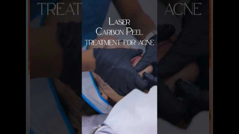 Laser Carbon Peel Treatment for acne | Benefits of Laser Carbon Peel | Best Dermatologist in Noida