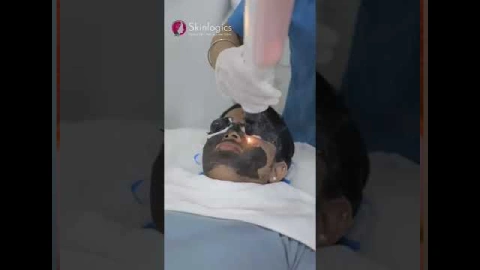 Say bye - bye to Acne, Open Pores, Blackheads and Oily skin with Carbon Laser Peel