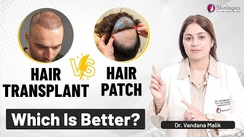 Hair Transplant vs. Hair Patch: Which one is better? | Haircare | Dr. Vandana Malik