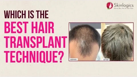 FUE vs FUT Hair Transplant - Which is better? | Skinlogics Derma Clinic