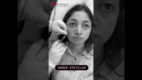 Undereye Filler Treatment | Dermal filler