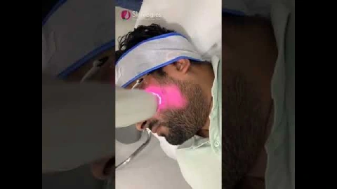 Laser Beard Shaping | Beard Shaping