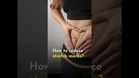 How to get rid of Stretch Marks? | Best Dermatologist in Noida | Skinlogics Clinic