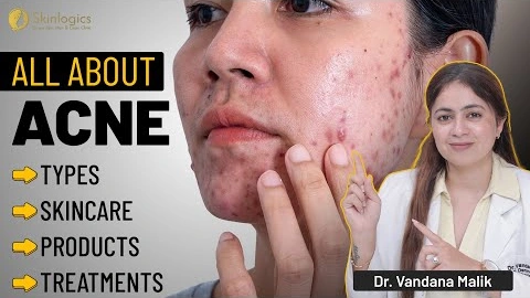 All About Acne: Causes, Types & How to Treat It Right | Dr. Vandana Malik | Skinlogics Clinic