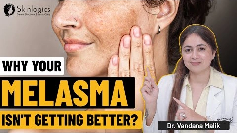How To Get Rid Of Melasma | Melasma Explained: Causes, Types & Best Treatments | Dr. Vandana Malik