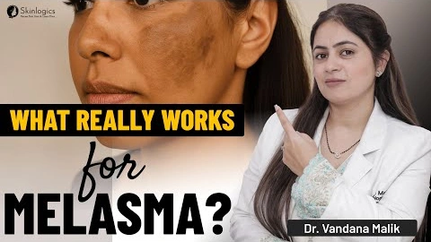 Why Melasma Isn’t Improving | Myths vs Real Treatments | Dr. Vandana Malik | Skinlogics Clinic