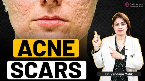 TCA Cross for Acne Scars | Acne Scars Treatment | Dr. Vandana Malik | Skinlogics Clinic