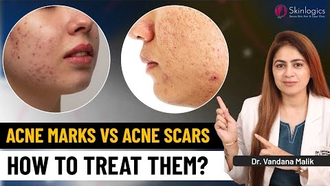 Acne Scars vs Acne Marks | Acne Scars Treatment | Dr. Vandana Malik | Skinlogics Clinic