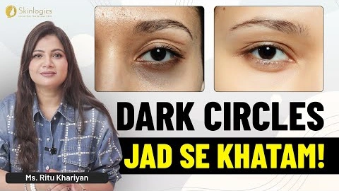 How to Get Rid of Dark Circles: Tips, Remedies & Treatments | Ms. Ritu Khariyan | Skinlogics Clinic