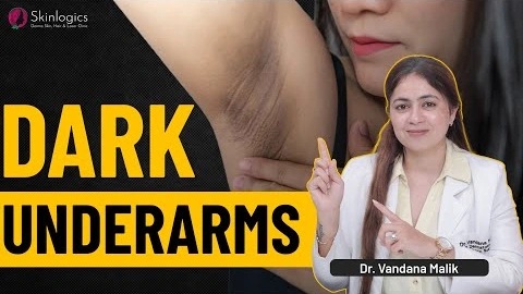 How to get rid of Dark Underarms | Acanthosis Nigricans Treatment |Skinlogics Clinic