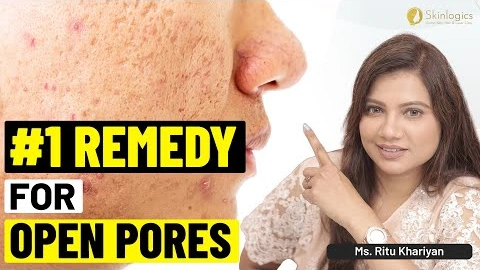 Home Remedies for Open Pores | Tips to Minimize Pores | Ms. Ritu Khariyan | Skinlogics Clinic