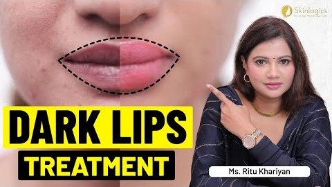 How to Get Pink Lips? | Dark Lips Pigmentation Treatment | Ms. Ritu Khariyan | Skinlogics Clinic