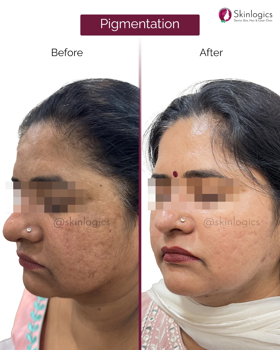 Pigmentation Treatment