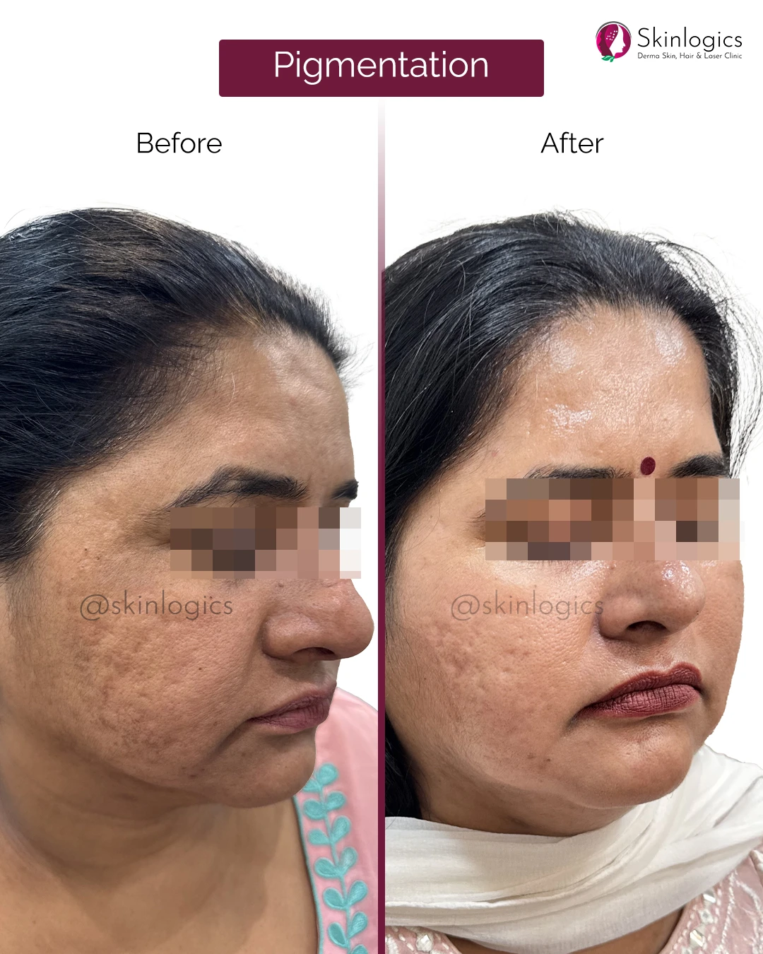 Pigmentation Treatment
