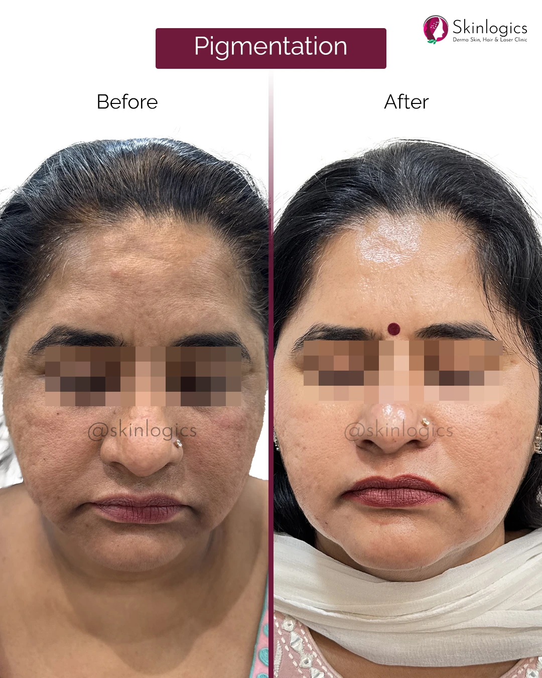 Pigmentation Treatment