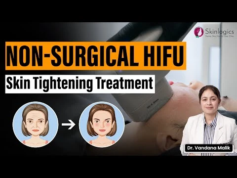 What does HIFU do to your face | hifu non surgical facelift | Best Skin Specialist in noida