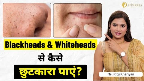 How to Get Rid of Blackheads & Whiteheads Permanently? | Ms. Ritu Khariyan | Skinlogics Clinic